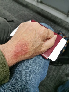 Verletzung vom Airbag